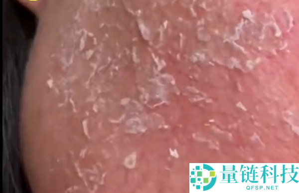 男子以油养肤致使脸部疯狂掉皮 大夫:过油致使接触性皮炎