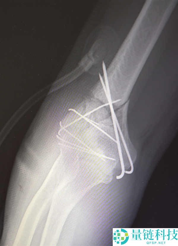 男人13米坠落摔出30多块碎骨头 大夫拼图式手术救回