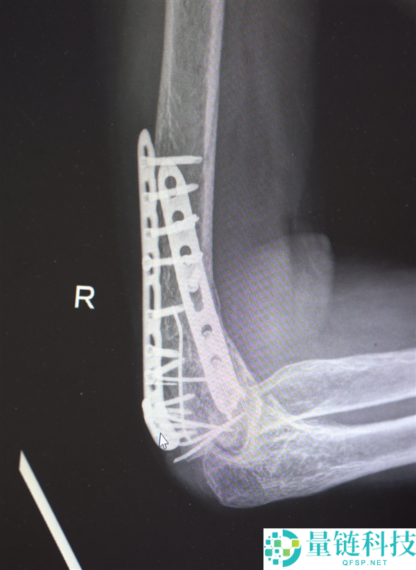 男人13米坠落摔出30多块碎骨头 大夫拼图式手术救回