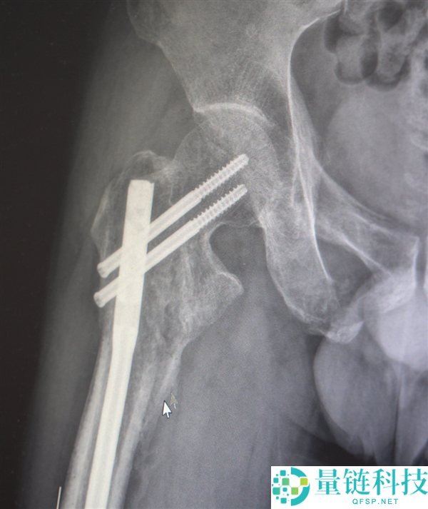 男人13米坠落摔出30多块碎骨头 大夫拼图式手术救回