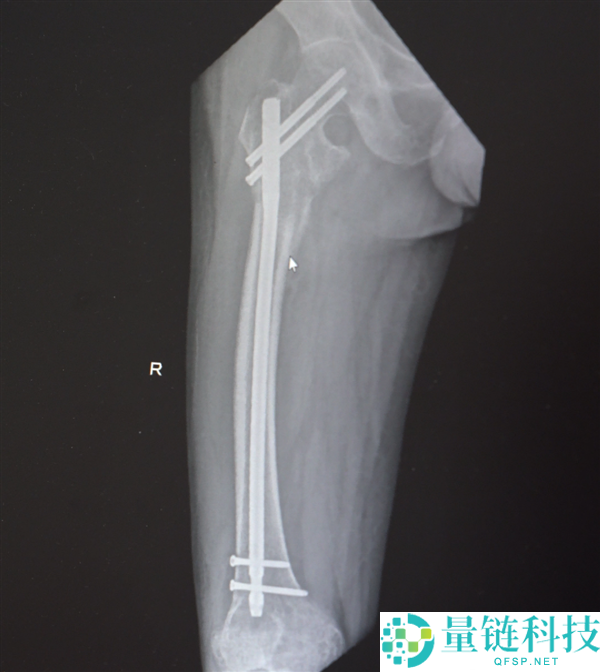 男人13米坠落摔出30多块碎骨头 大夫拼图式手术救回