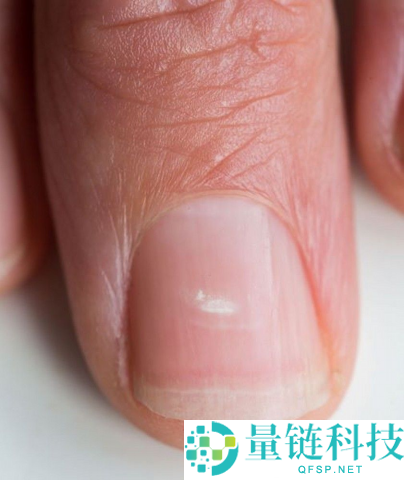 指甲为什么总从这个处所断开 是缺钙了吗