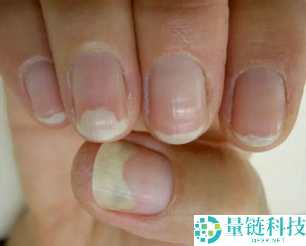 指甲为什么总从这个处所断开 是缺钙了吗