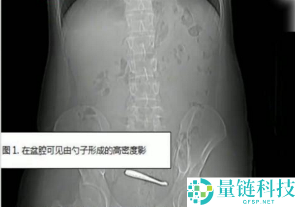 瞠目结舌：南京一小伙腹痛CT查出肠道卡2把勺子 婉言吞下时没发觉