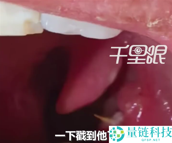 男人竹签卡喉误认为刀片嗓：吃8天药越吃越严重