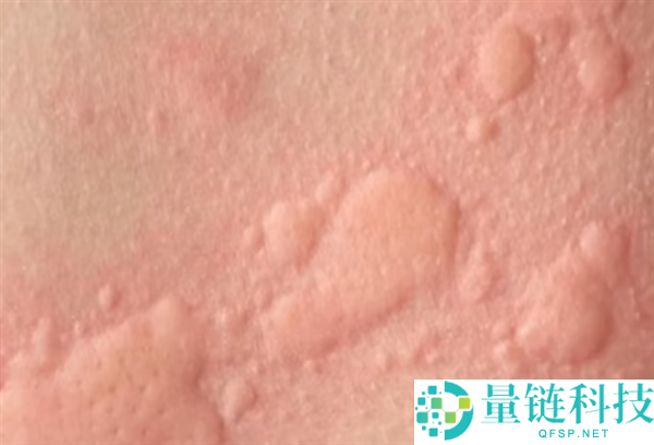 无治愈手腕只能靠药物减缓 全球多国呈现麻疹疫情反弹