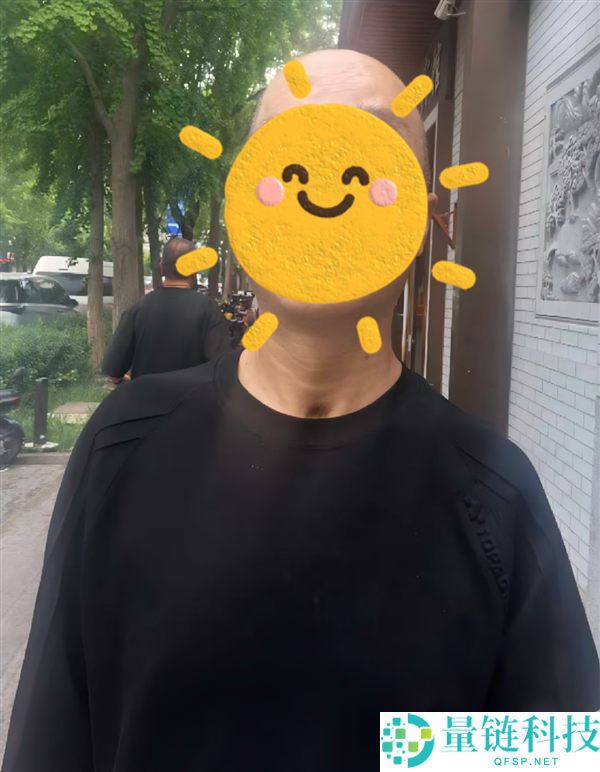 男子骑电摩不戴头盔与汽车相撞,颅骨碎裂17块惨剧揭秘