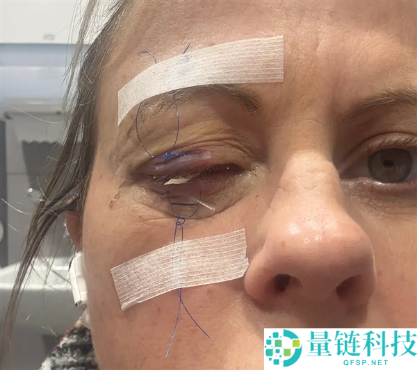 男子因洗脸忘摘隐形眼镜,一只眼被寄生虫咬出洞的惊人案例