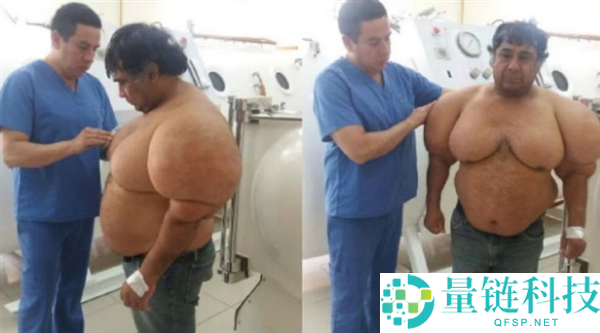 深潜后上升太快 秘鲁潜水员身体肿成鼎力海员：太苦楚,