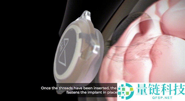 1.5秒植入,马斯克脑机接口公司手艺新打破 超万人守候上脑