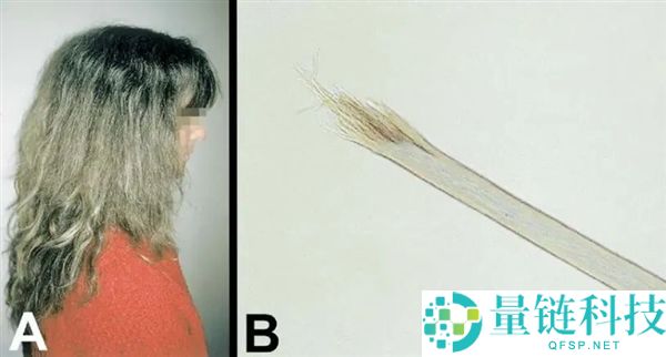 头发开叉其实是种病 良多人轻忽了,3步就能改良