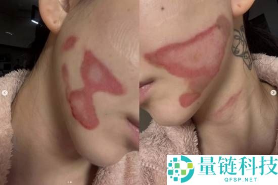 烧的太惨烈,韩国女星做医美居然致使面度灼伤