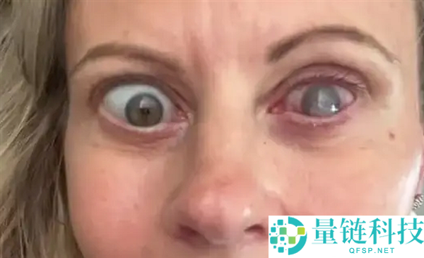男子因洗脸忘摘隐形眼镜，一只眼被寄生虫咬出洞的惊人案例